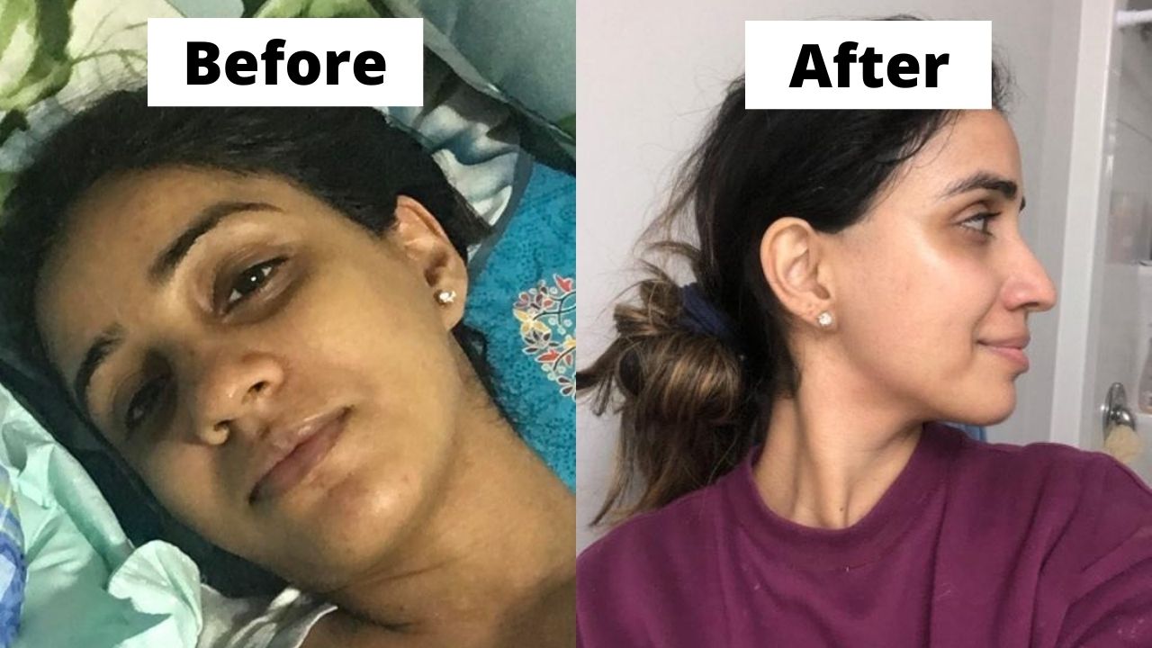 Before and after hyperpigmentation brown tan skin skincare products 1.jpg